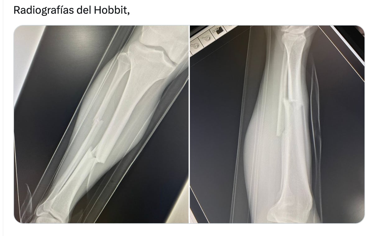Filtran la radiografía de la fractura del Hobbit Bermúdez