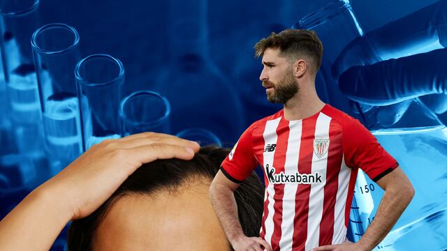 Se estaba quedando calvo y comenzó un tratamiento pero eso le provocó doping positivo