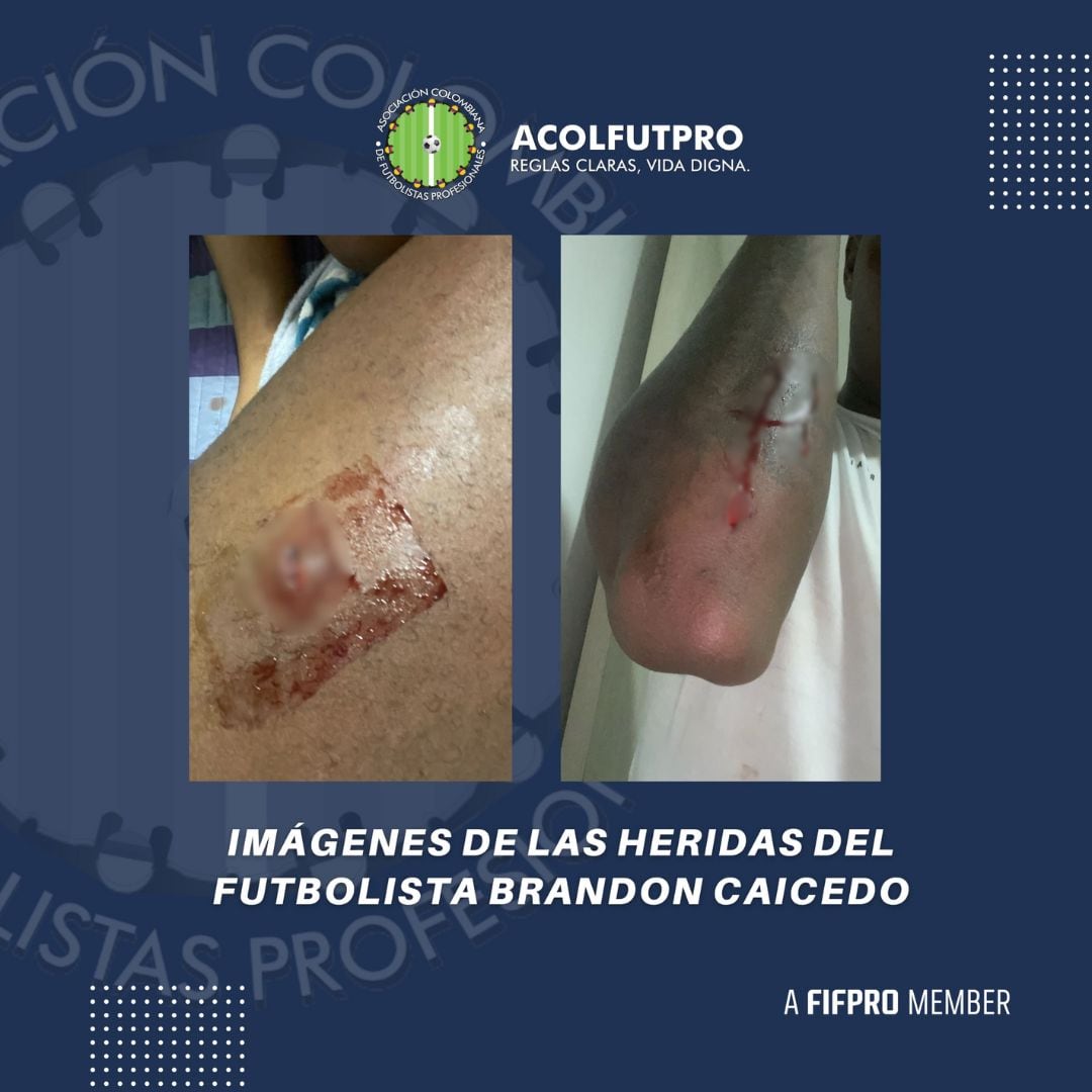 Apuñalan a jugador por los malos resultados de su equipo; se identificaron como barristas