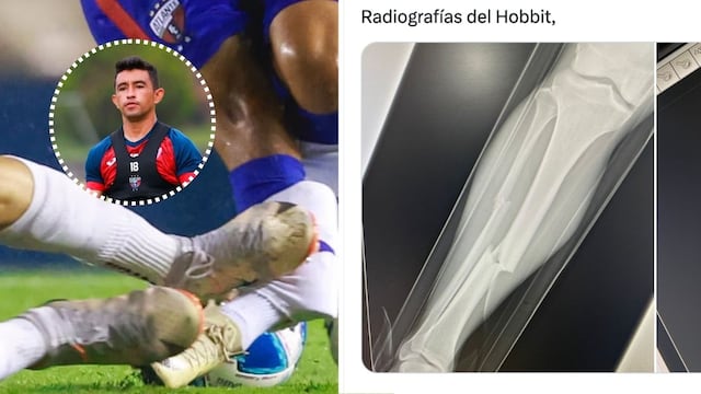 Filtran las radiografías de la fractura sufrida por el Hobbit Bermúdez
